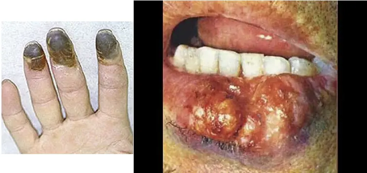 Hydra AEME - causes toxic encephalopathy.webp